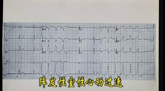 短阵室性心动过速362例动态心电图分析